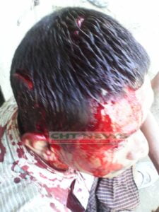 খাগড়াছড়ির কমলছড়িতে সেটলার হামলায় গুরুতর আহত পান্দুক্যা চাকমা। # ফাইল ছবি