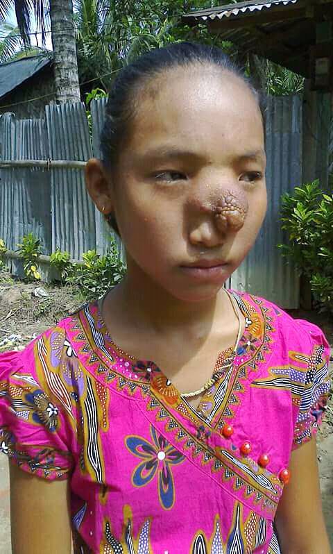 সিল টিউমারে আক্রান্ত ঞোসিনহ্লা মারমা